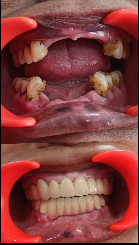 Full mouth dental implants before and after at House Of Dentistry Dehradun